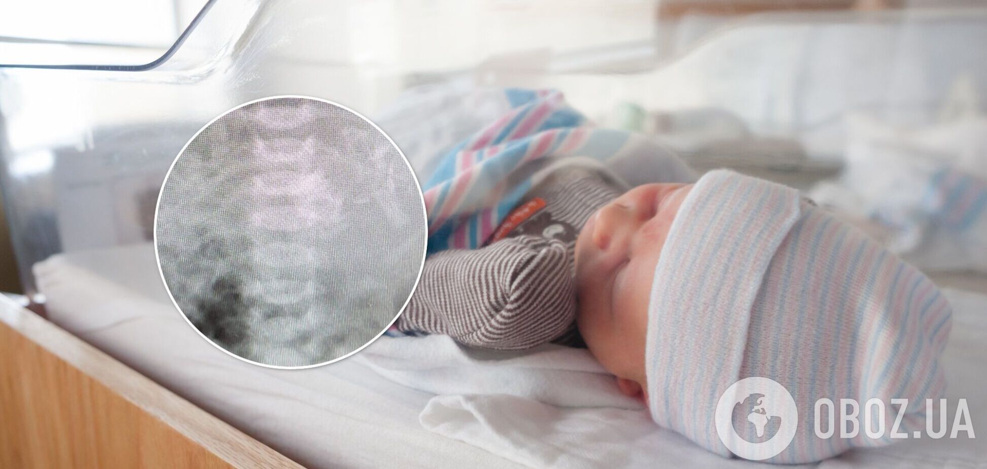 В Ізраїлі народилася дівчинка з близнюком у животі. Фото