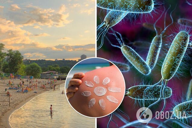 Гепатит, грибок и кишечная палочка: какие болезни можно подхватить на пляжах Украины и как уберечься