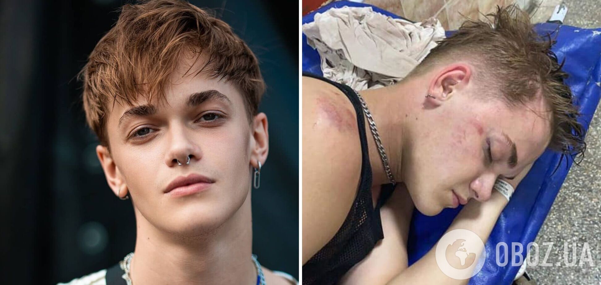 Избитый танцор Дорофеевой вышел из комы