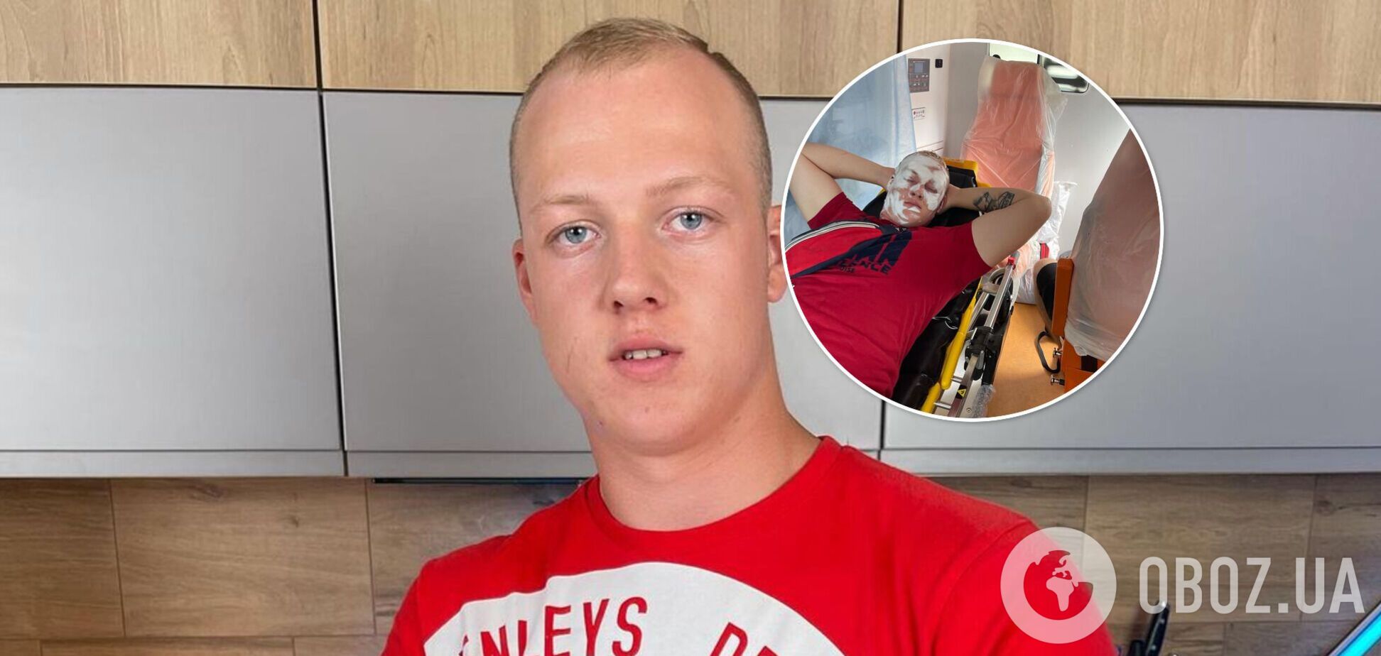Блогер приготував 78-кілограмовий Skittles і отримав опік обличчя. Фото і відео