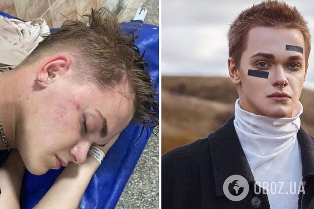 Вітчим побитого танцюриста Дорофєєвої розповів про його стан: ледве говорить і дуже слабкий. Ексклюзив