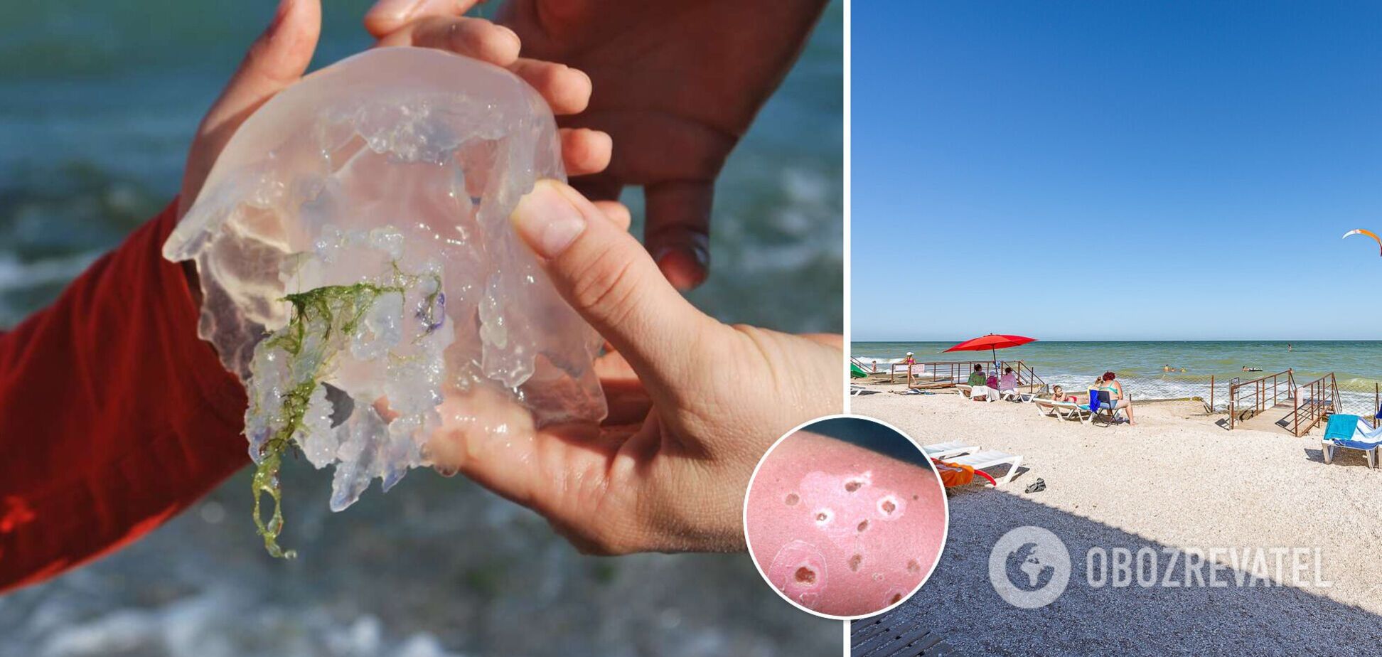 Туристка з Кирилівки показала, якою буває реакція на укус медузи. Відео