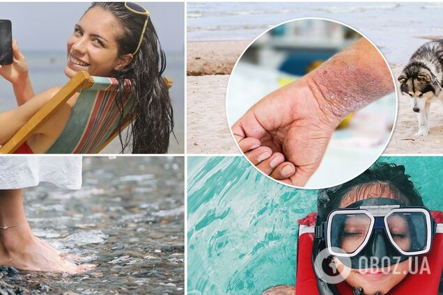 Подцепили грибок, лишай и чесотку на пляже? Дерматолог говорит, что это реально