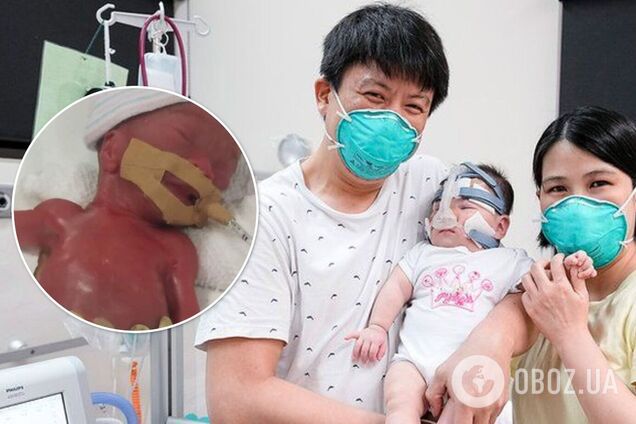 'Самого маленького ребенка при рождении' выписали из больницы: девочка родилась весом с яблуко. Фото