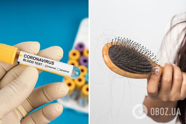 Врач рассказал, с чем может быть связано выпадение волос после COVID-19