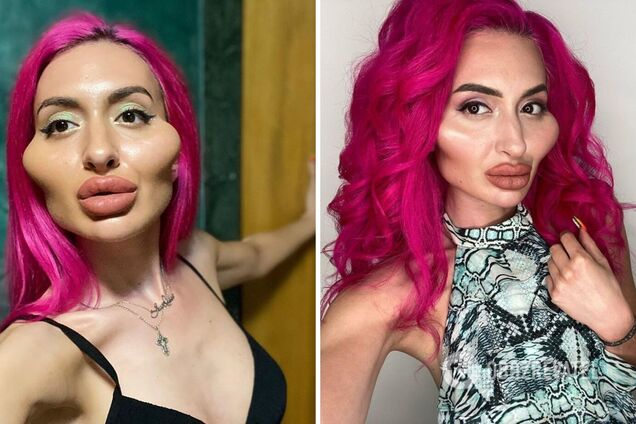 Украинка с самыми большими скулами в мире сделала очередную пластическую операцию. Фото