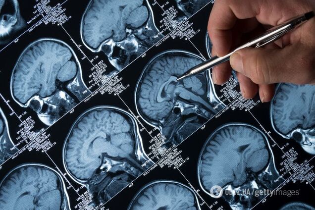 Ранние симптомы опухолей мозга: как не пропустить заболевание