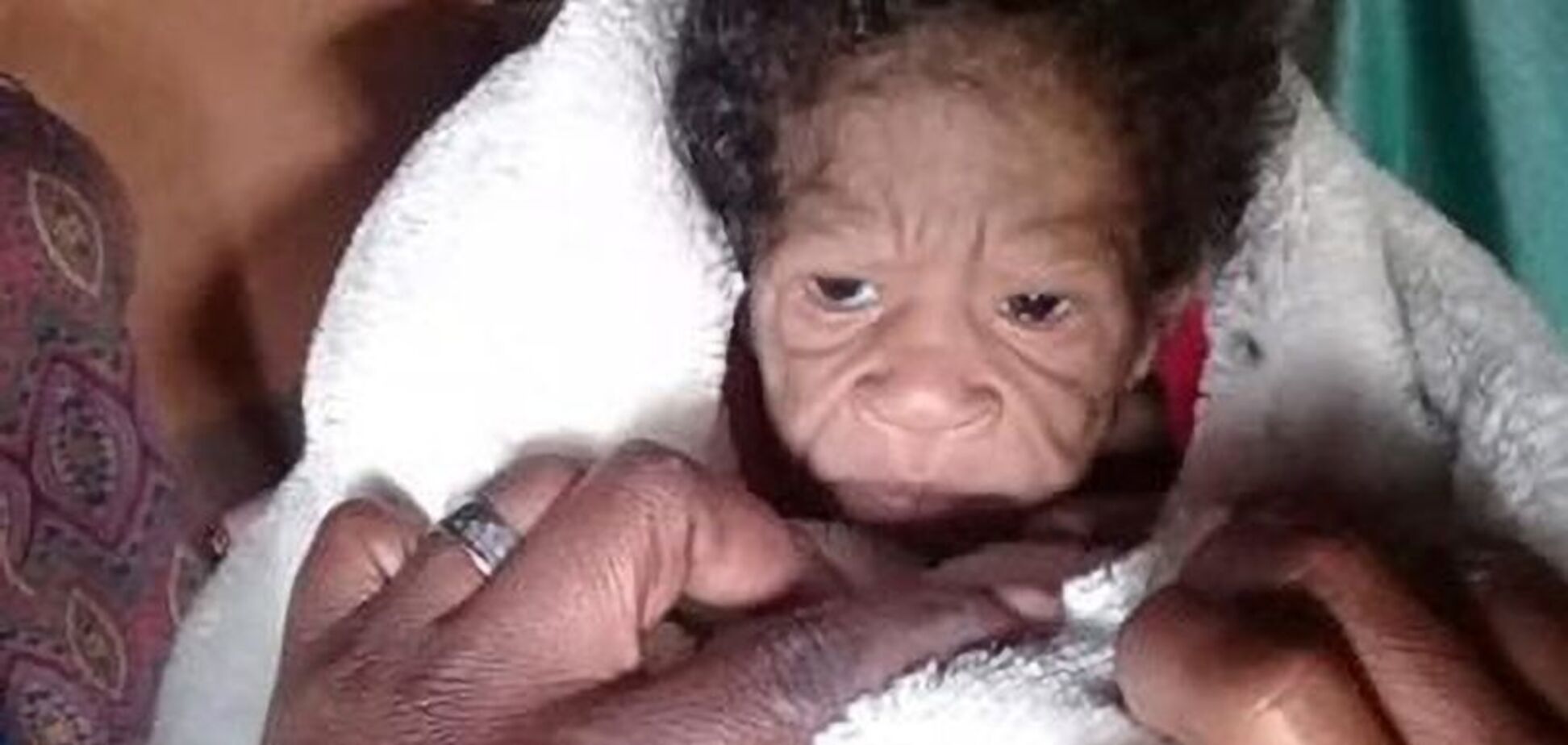 У ПАР жінка народила дитину з рідкісною мутацією. Фото