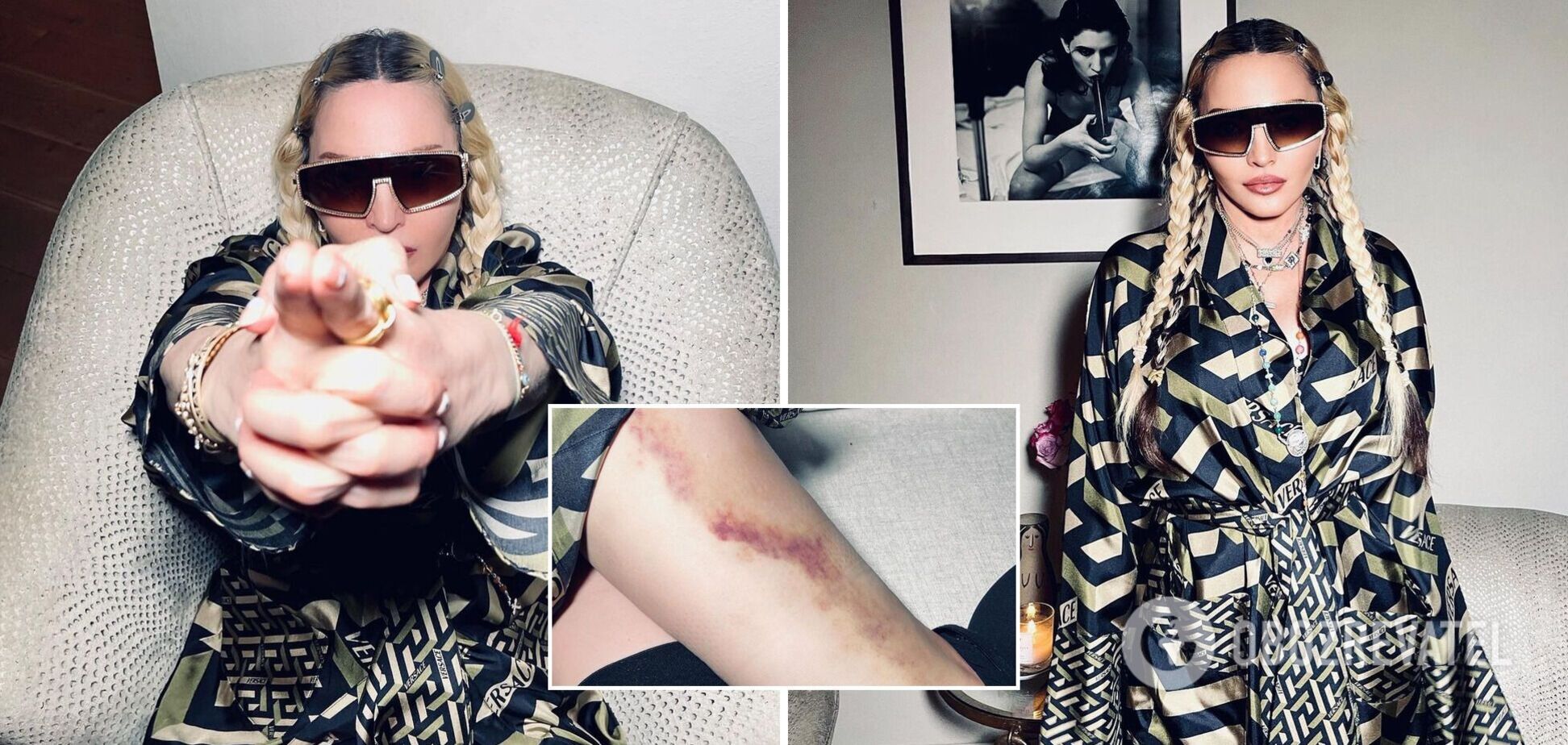 63-летняя Мадонна с гигантским синяком испугала подписчиков: что произошло