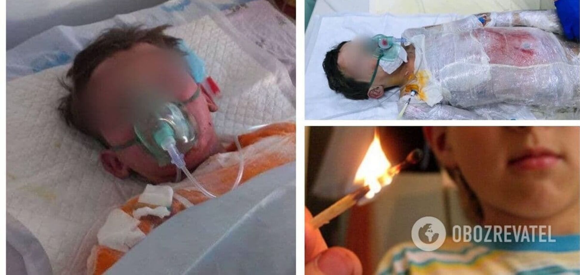 На Кіровоградщині 10-річний хлопчик вилив на себе бензин та підпалив сірники: за його життя борються лікарі