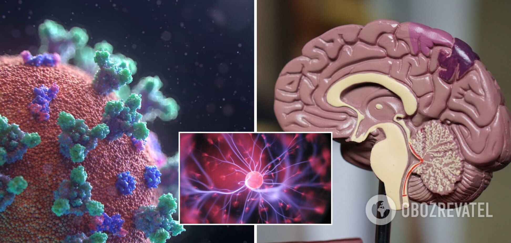 COVID може вражати мозок сильніше за хворобу Альцгеймера: нове дослідження