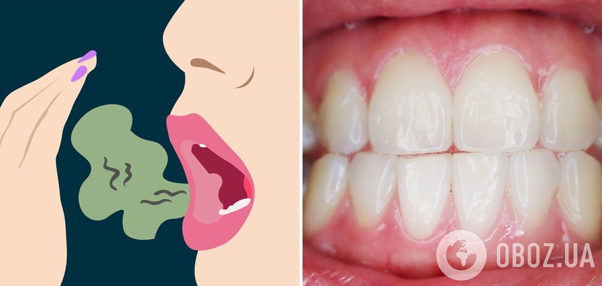 Неприємний запах з рота: лікарі назвали причини та способи боротьби