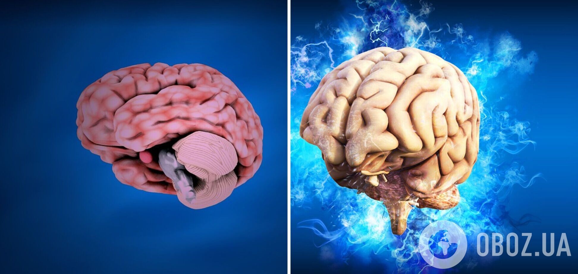 Що треба знати про розсіяний склероз: названо первинні симптоми