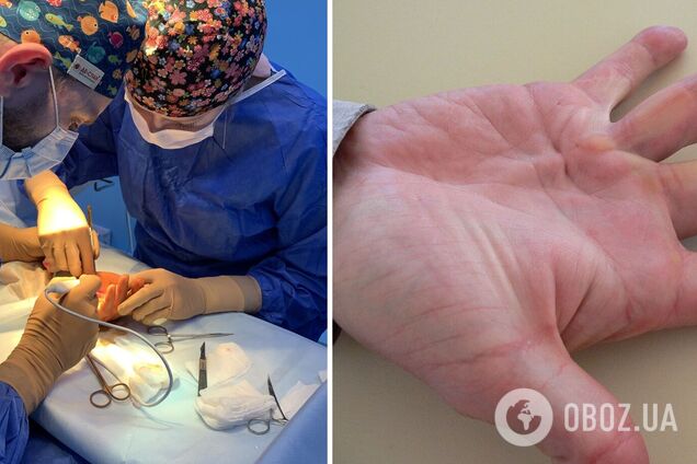 Багато хто звертається занадто пізно: лікар розповів про небезпечну хворобу – руки стають як у 'Людини-павука'