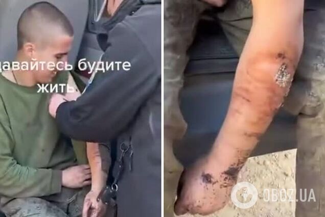 Уровень медицины 'второй армии мира': ВСУ взяли в плен оккупанта, в ранах которого уже завелись черви. Видео