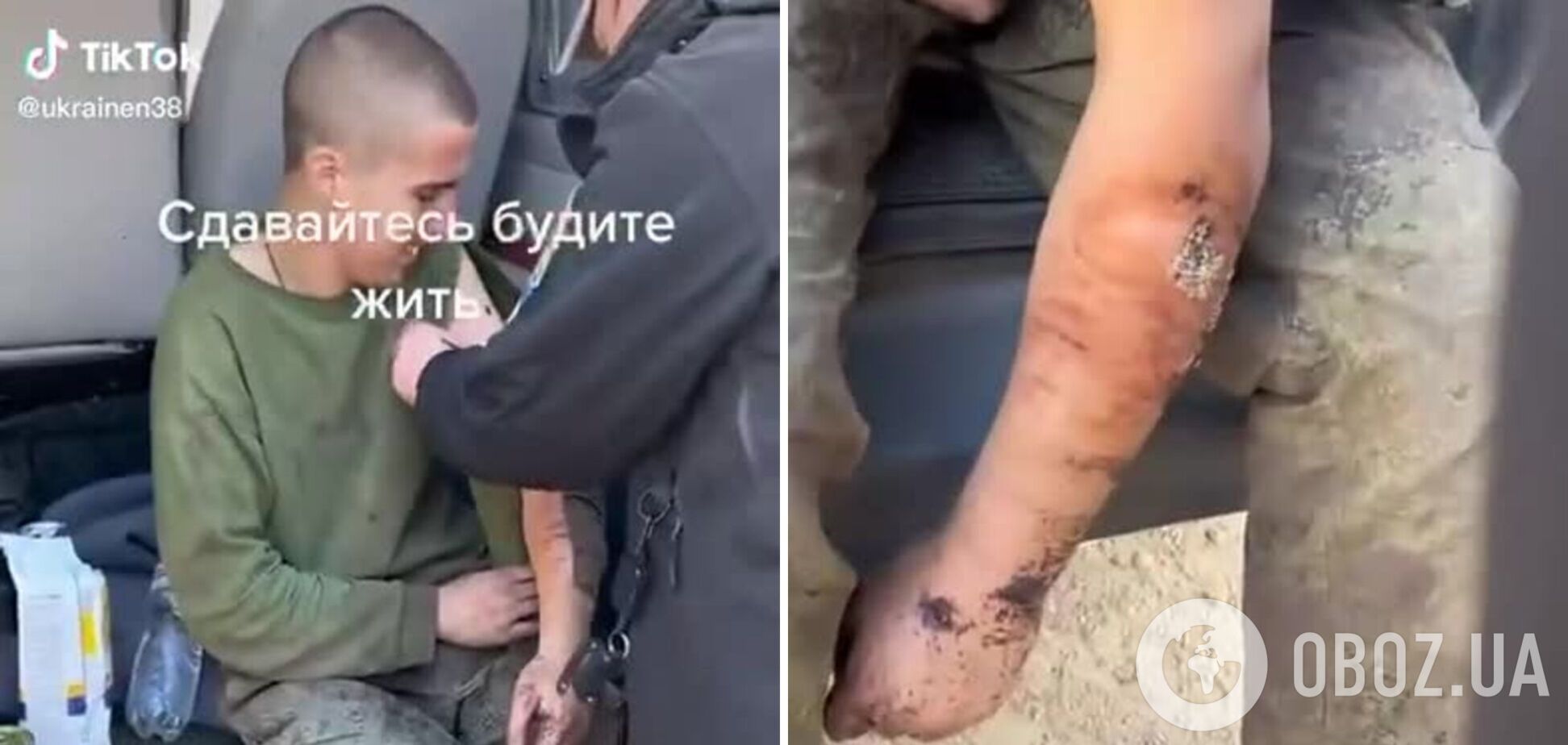 Уровень медицины 'второй армии мира': ВСУ взяли в плен оккупанта, в ранах которого уже завелись черви. Видео