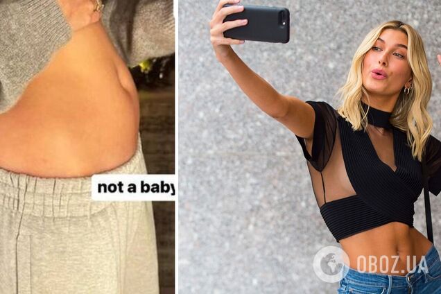 'Размером с яблоко': Хейли Бибер рассказала об опасной кисте, из-за которой выглядит беременной. Фото