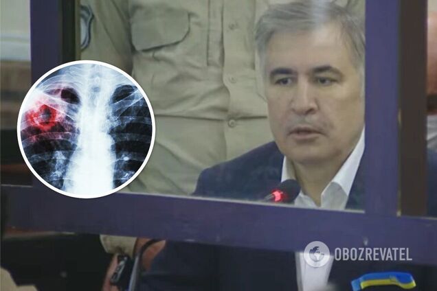 У Саакашвили в тюрьме диагностировали деменцию и туберкулез: что известно о его состоянии