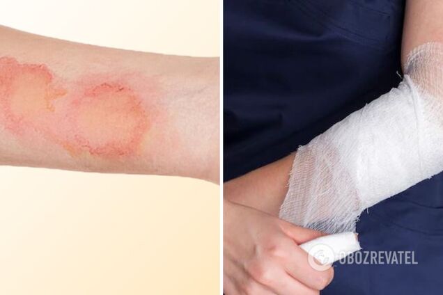 Що робити в разі опіку: першочергові поради від МОЗ