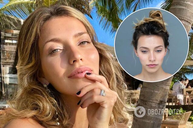 Регіна Тодоренко вперше показала своє невиліковне шкірне захворювання