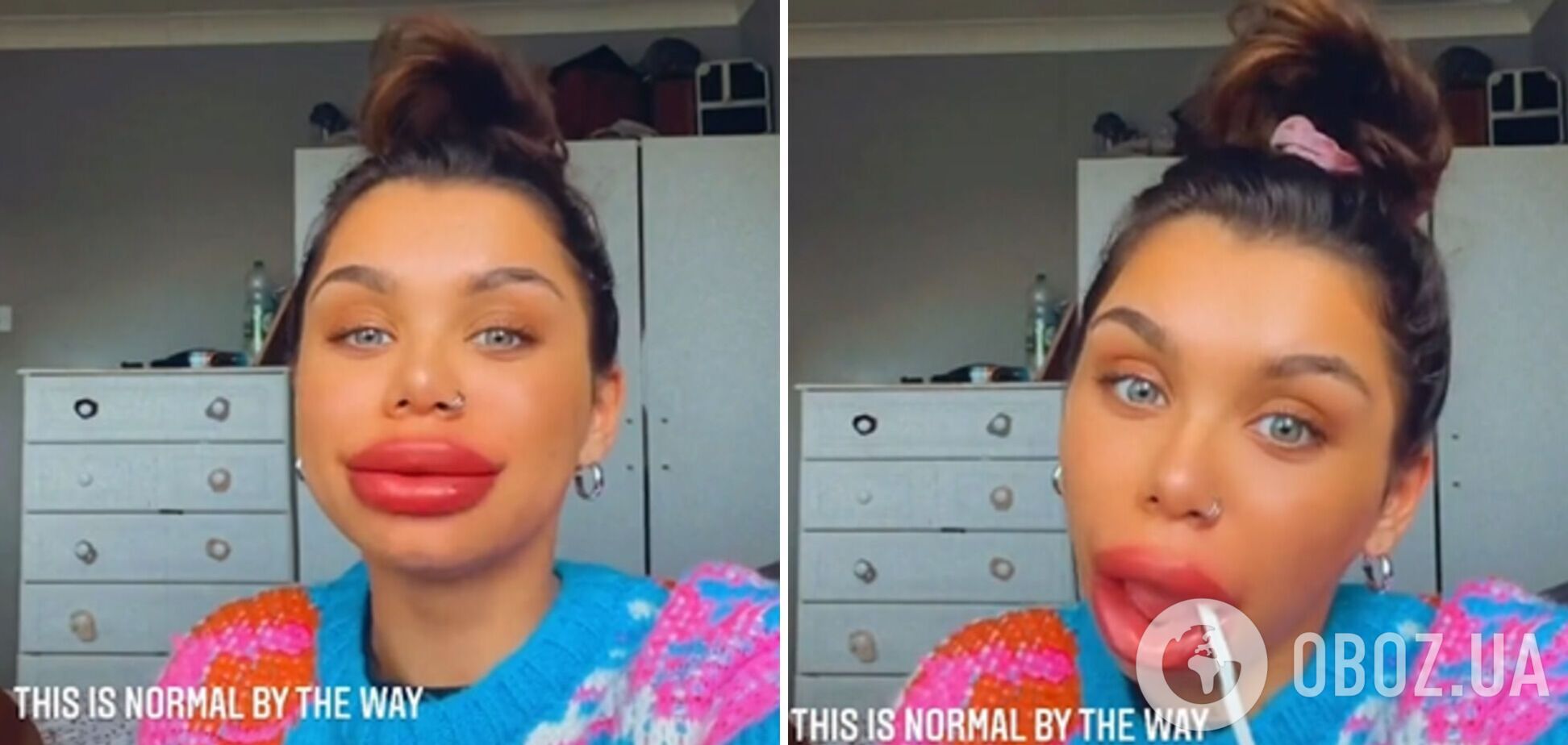 Жінка вирішила зменшити губи, але їх роздуло на пів обличчя. Відео