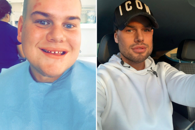 Британец потратил $32 тыс. на 'идеальную внешность' для соцсетей, но теперь посещает психотерапевта