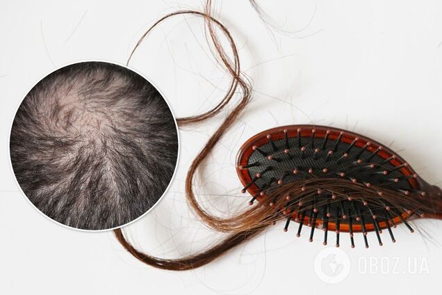 Не растирайте и не скручивайте полотенцем: врачи рассказали, как предотвратить выпадение волос