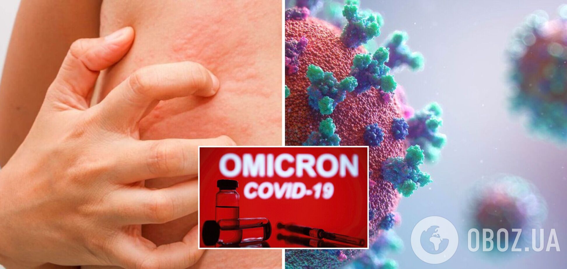 Шість змін на шкірі можуть вказати на зараження Омікроном – лікарі