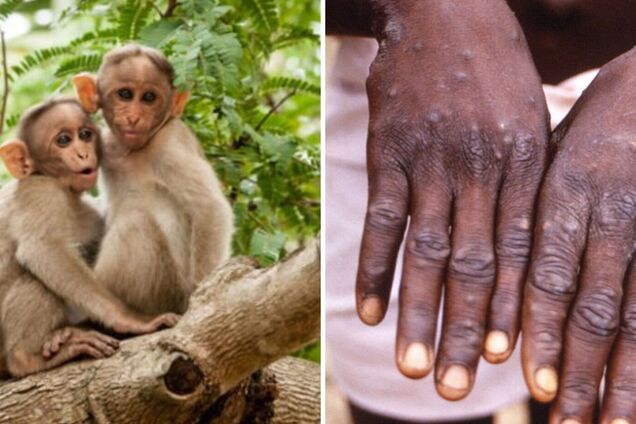 В Італії виявили віспу мавп