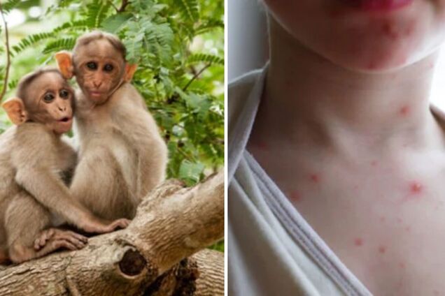 Віспа мавп: що треба знати ЛГБТ-спільноті та гомофобам