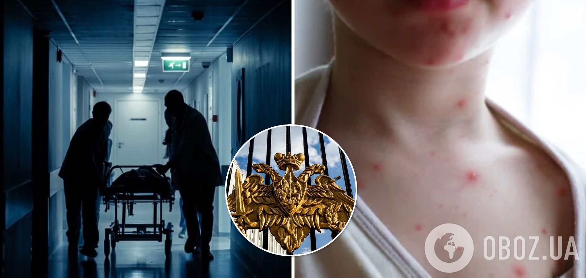 Оспа обезьян – к вспышке болезни может быть причастна Россия – что это за болезнь и как передается