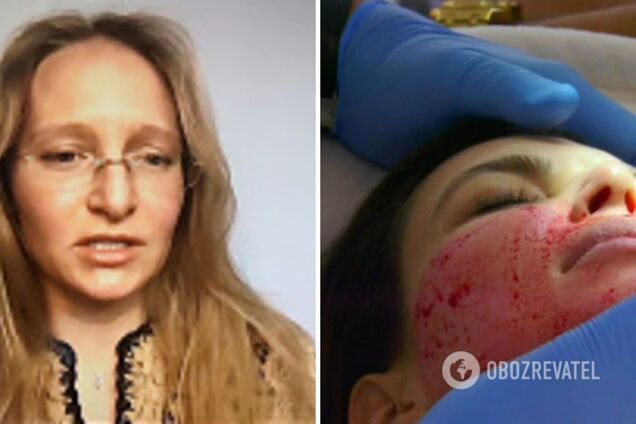 Донька Путіна Катерина Тихонова робила в Мюнхені 'вампірський ліфтинг'. Що це за процедура вартістю 4000 євро/сеанс