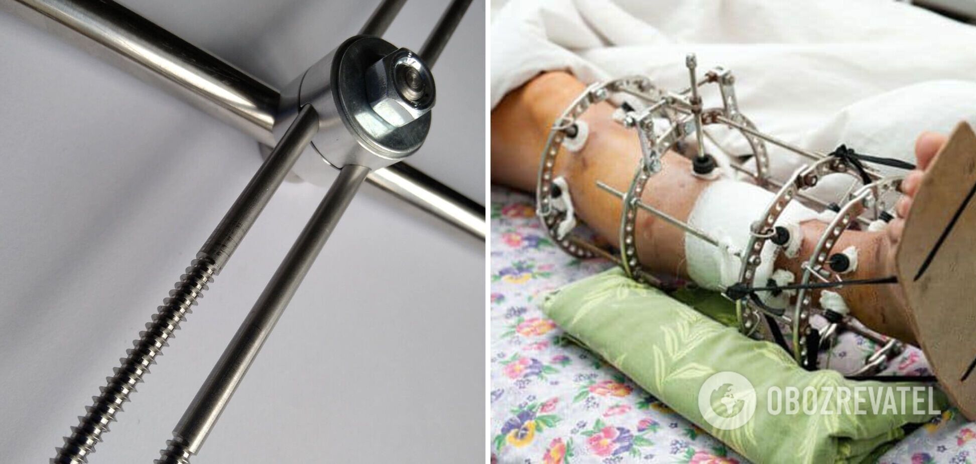 Раненым военным для спасения конечностей необходимы АВФ: волонтер обратилась за помощью