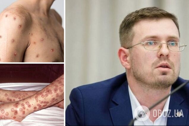 Звідки взялася мавпяча віспа і чи загрожує Україні епідемія: головний санлікар розповів про хворобу
