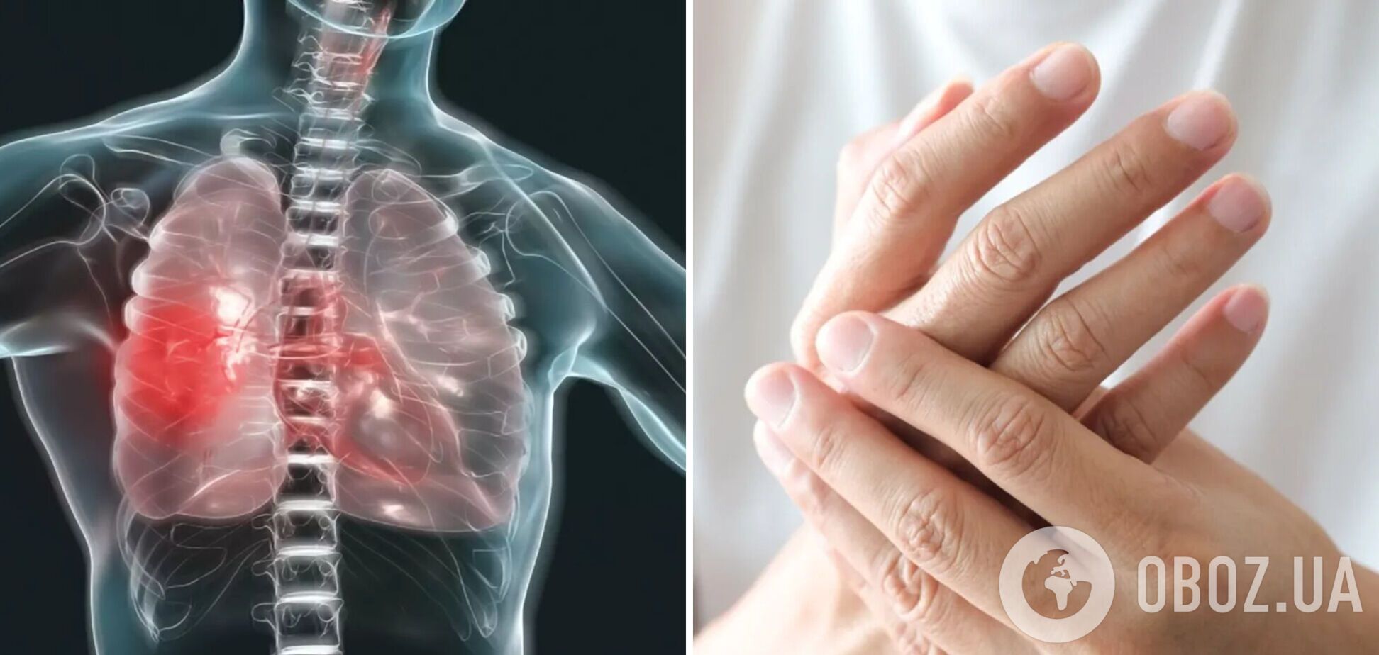 По руках людини можна 'прочитати' симптоми хвороб легень: як розпізнати небезпечний діагноз
