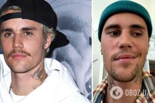 У Джастіна Бібера паралізувало половину обличчя: він звернувся до своїх фанатів за підтримкою. Відео