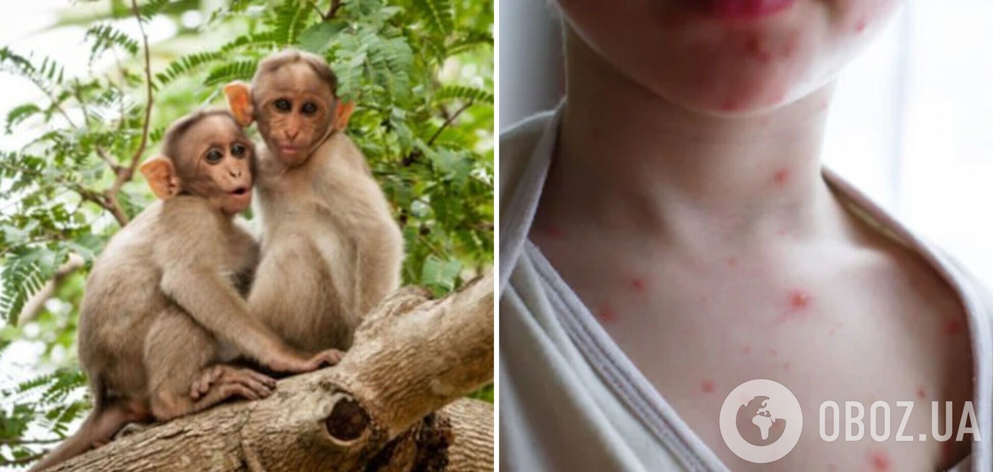 ВОЗ объявила глобальную чрезвычайную ситуацию из-за вспышки обезьяньей оспы