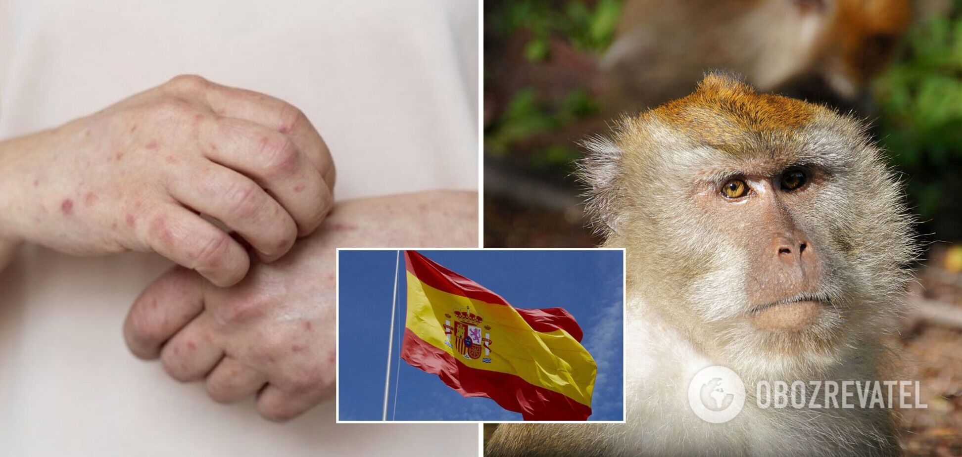В Іспанії і Бразилії зафіксували перші смерті людей від мавпячої віспи