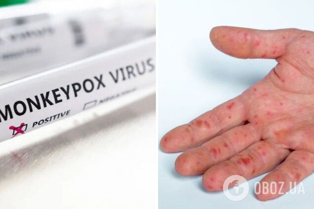 Друга в Європі: в Іспанії зафіксували ще одну смерть від мавпячої віспи