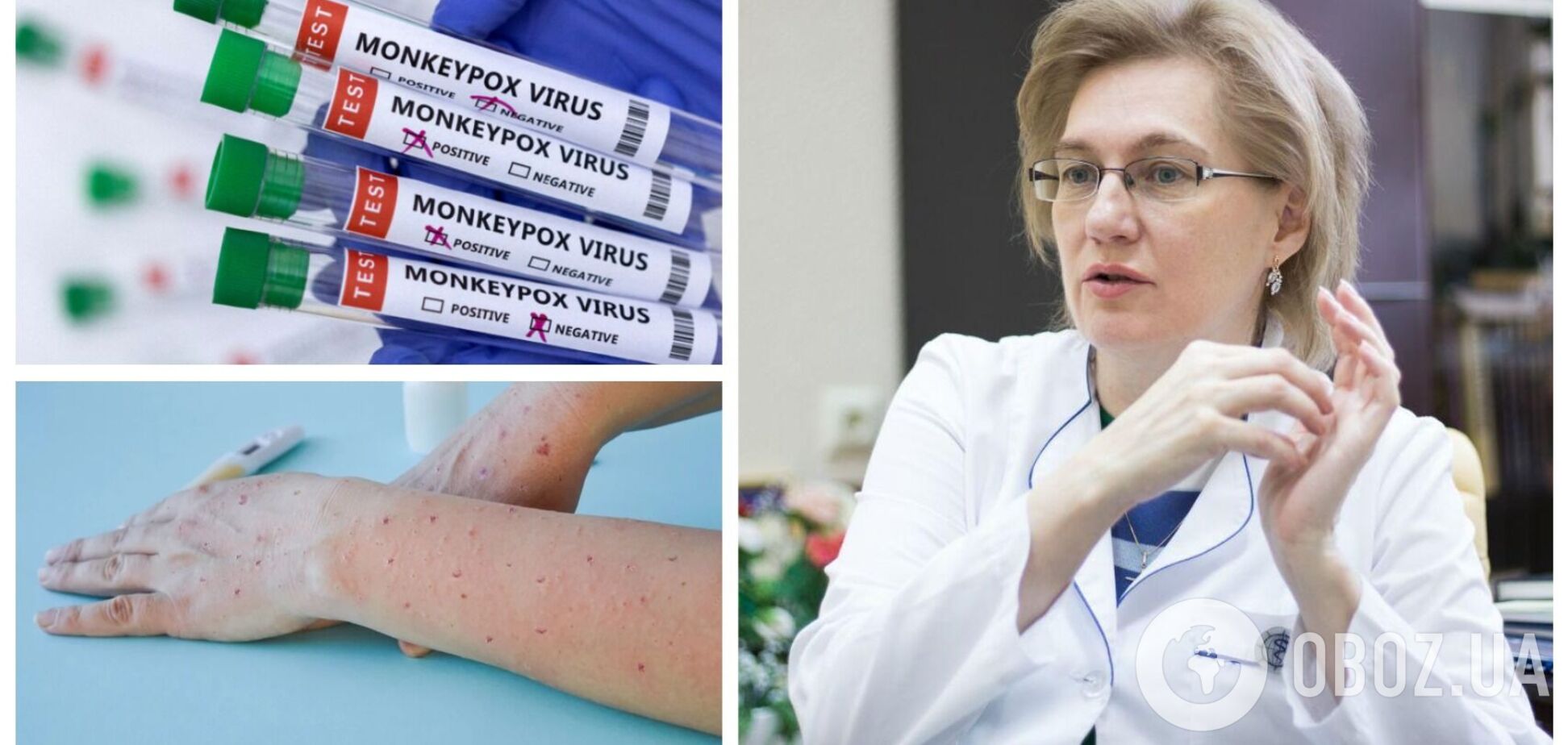 Є насторожуючий момент: Голубовська розповіла, чи може віспа мавп становити велику загрозу