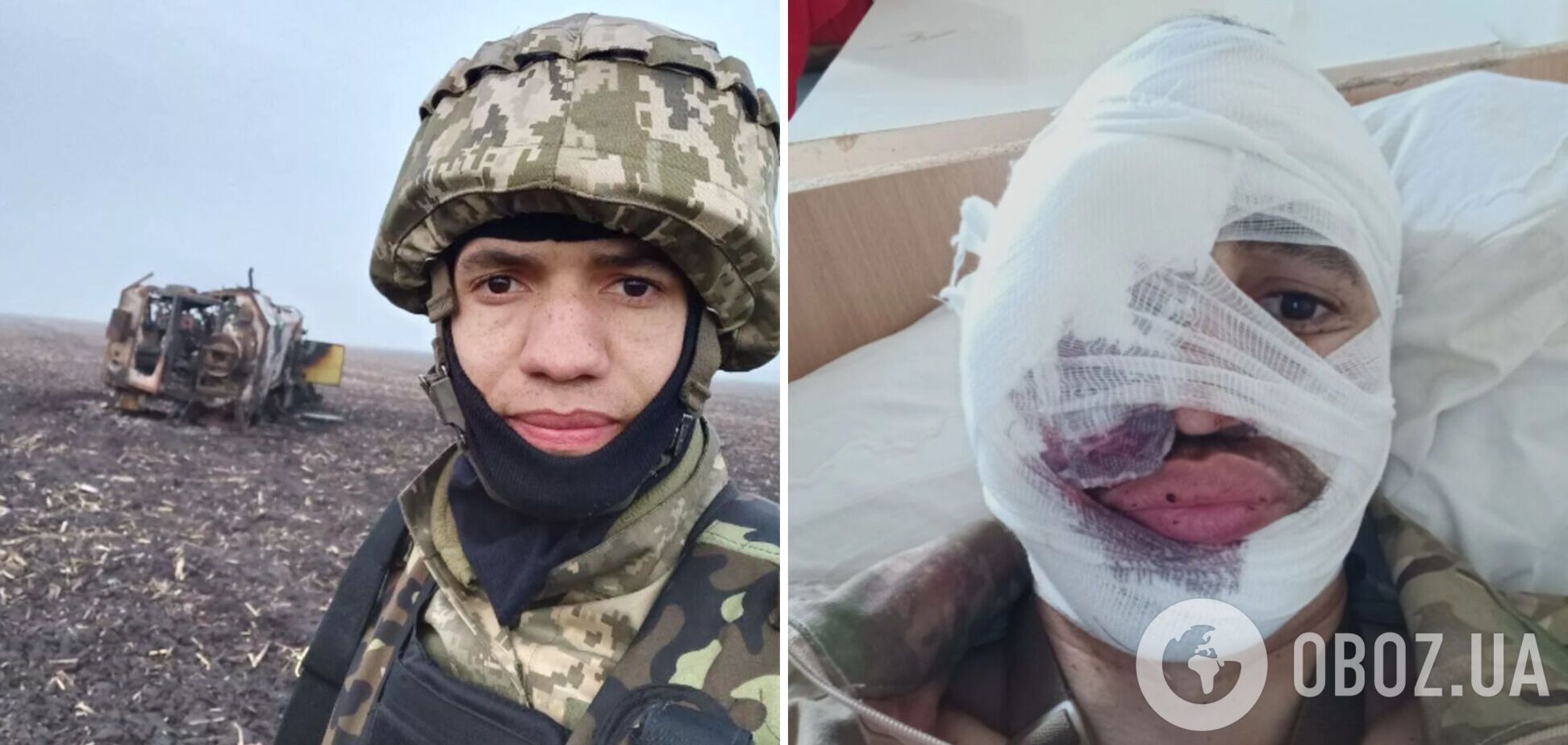 Український актор Стороженко, який дістав поранення на полі бою, показав обличчя після операції. Фото