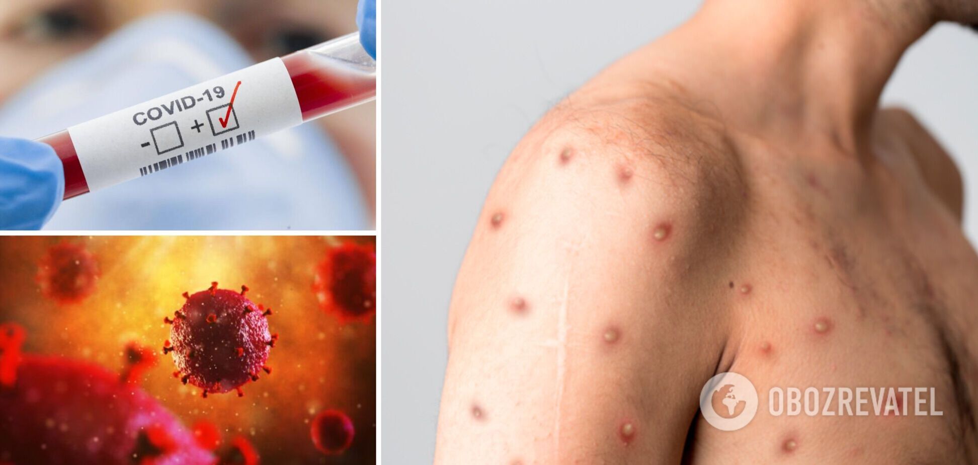 Італієць першим у світі одночасно отримав позитивний тест на зараження мавп'ячою віспою, COVID-19 та ВІЛ