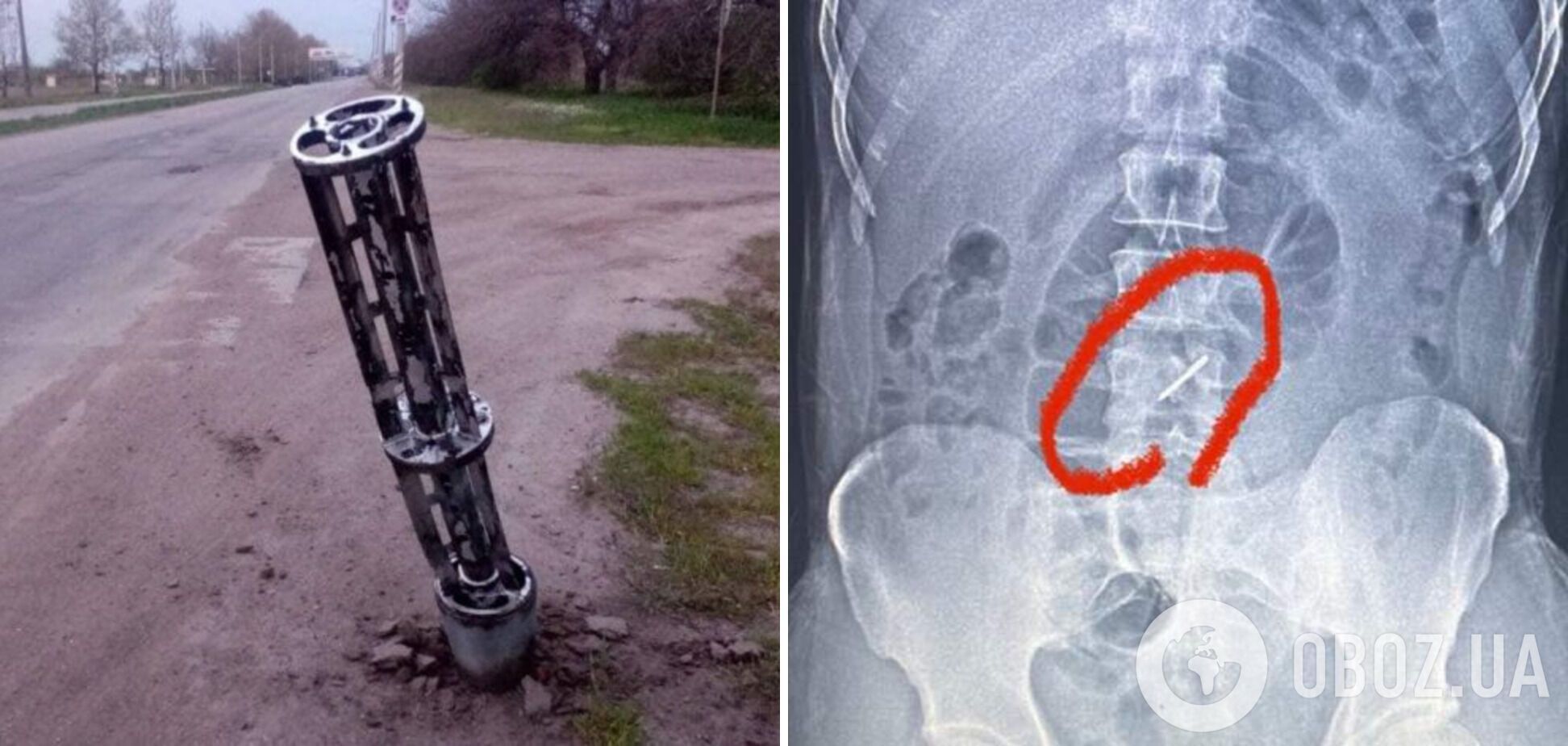 У хребті бійця ЗСУ застрягла 'стрілка' від касетної бомби