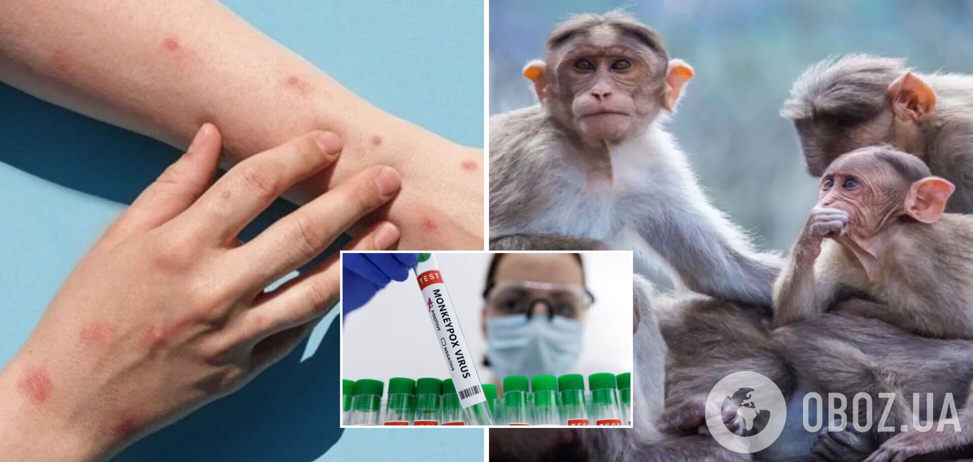В Украине подтвердили третий случай оспы обезьян: что известно о больных