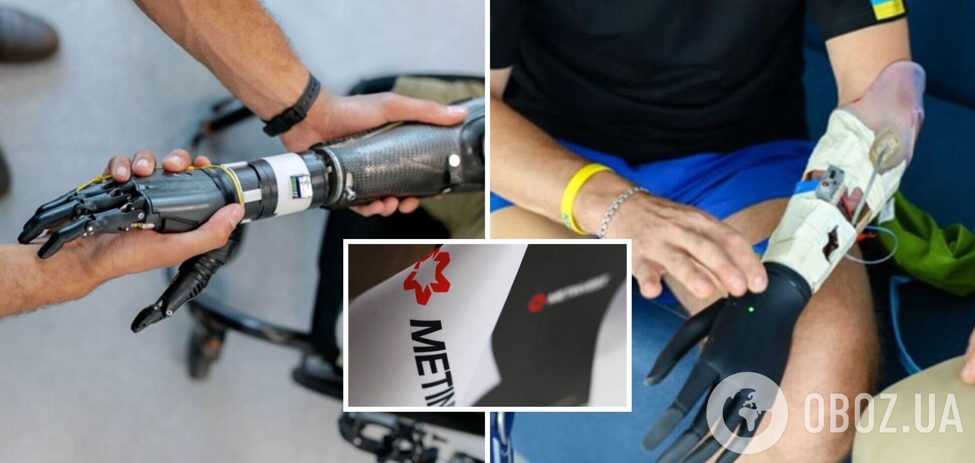 Вже 28 українців проходять процедуру протезування від проєкту 'Рятуємо життя'