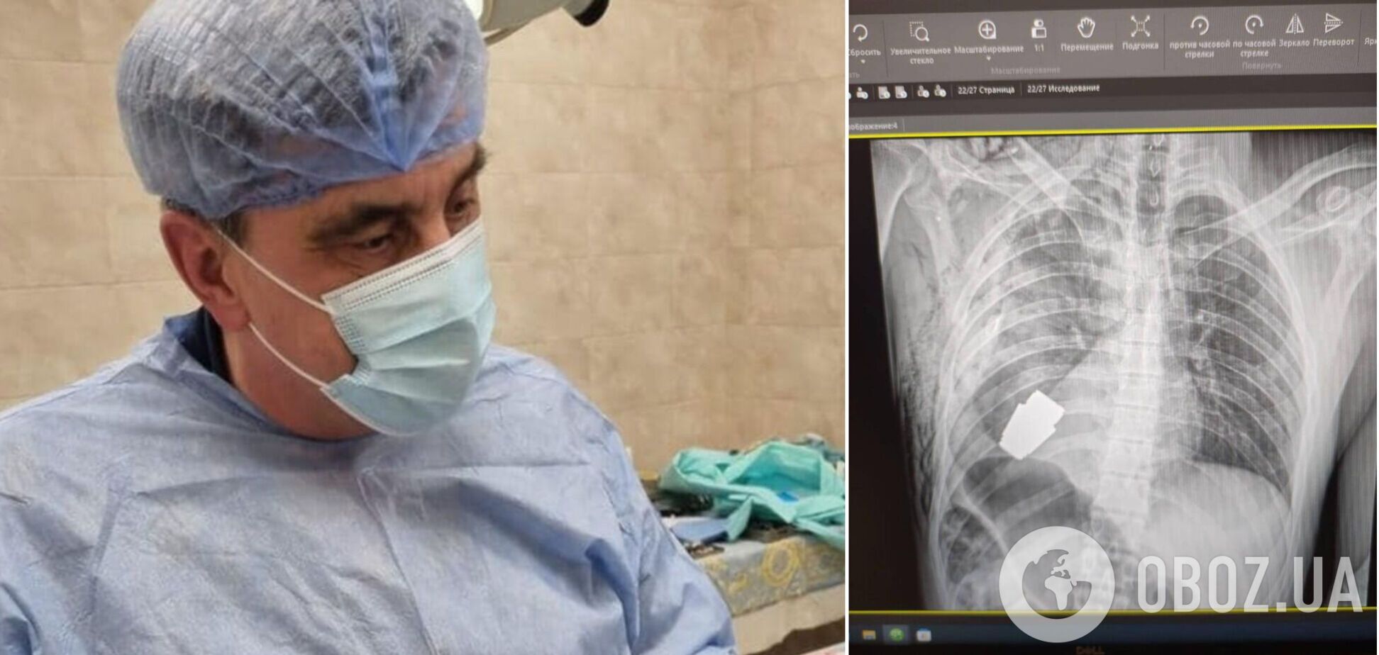 Українські хірурги провели унікальну операцію і дістали з тіла військовослужбовця гранату ВОГ, що не розірвалася. Фото
