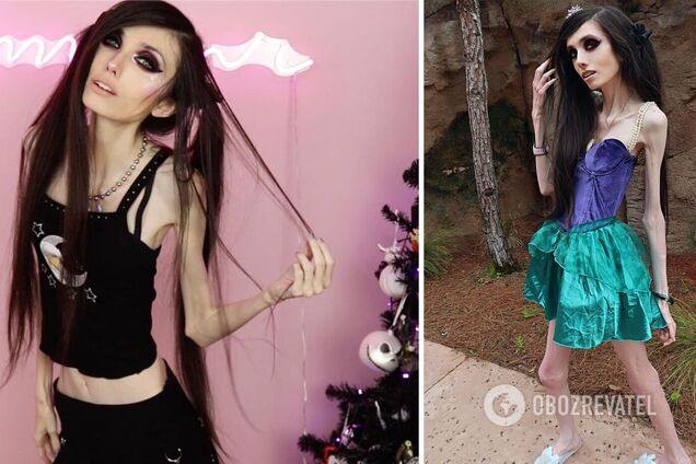 Звезда TikTok, страдающая анорексией, смутила поклонников новыми видео: как выглядит 29-летняя девушка
