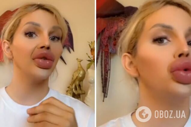 'Мне говорят, что я похожа на утку': фанатка пластики с огромными губами смутила сеть новой мечтой