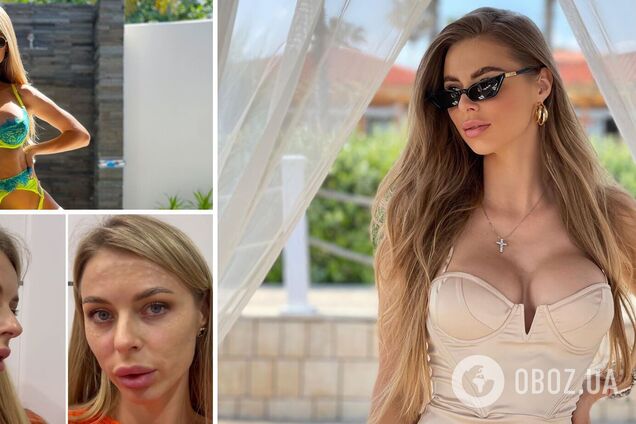 Жене футболиста сборной Украины изуродовали лицо косметической процедурой. Видео