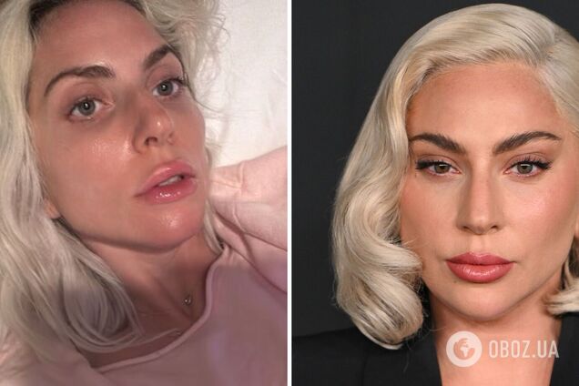 37-летняя Леди Гага разочаровала поклонников из-за 'ботокса и филеров' в лице. Фото до и после